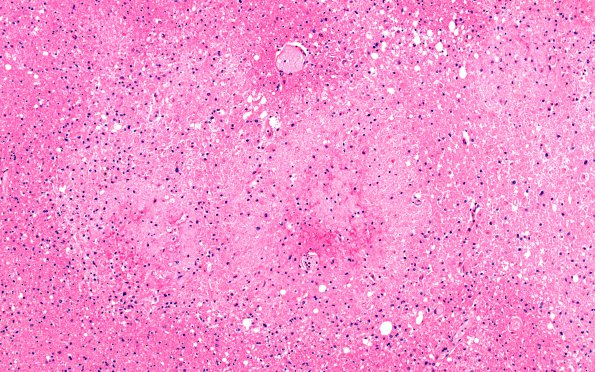 10B2 Infarct, fat emboli (Case 10) H&E 5