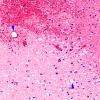 10B3 Infarct, fat emboli (Case 10) H&E 2 copy