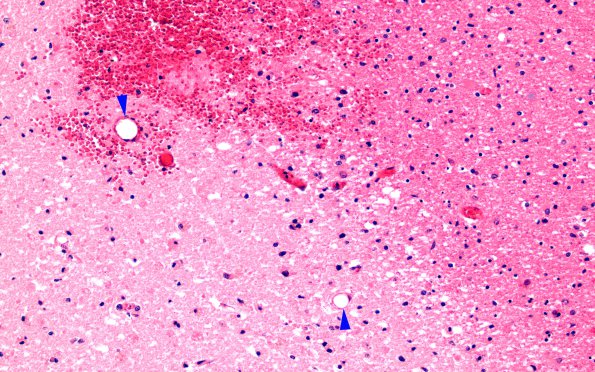 10B3 Infarct, fat emboli (Case 10) H&E 2 copy