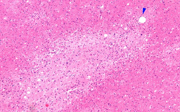 10B4 Infarct, fat emboli (Case 10) H&E 6 copy