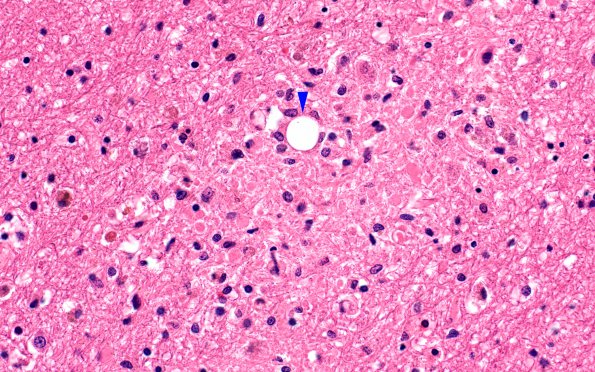 10B5 Infarct, fat emboli (Case 10) H&E 4 copy