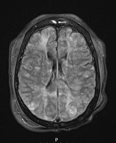 11A1 Fat Embolism (Case 11) FLAIR - Copy