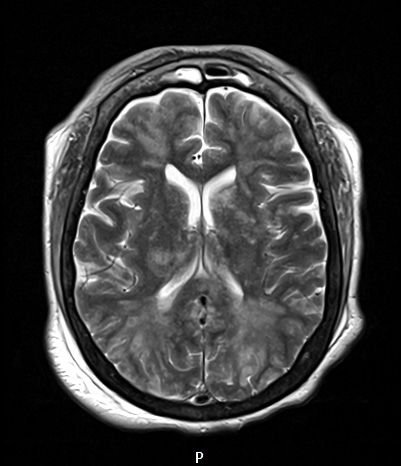 11A2 Fat Embolism (Case 11) T2 2 - Copy