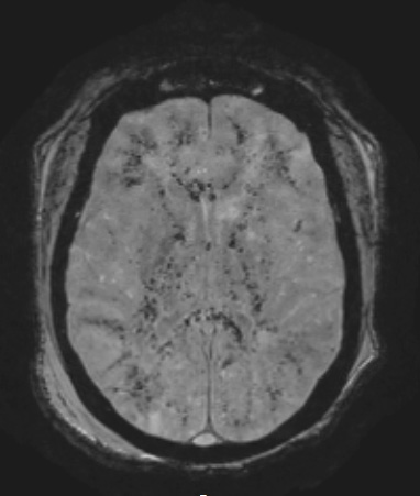 11A3 Fat Embolism (Case 11) SWI - Copy