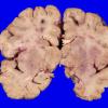 11B1 Fat Embolism (Case 11) _1