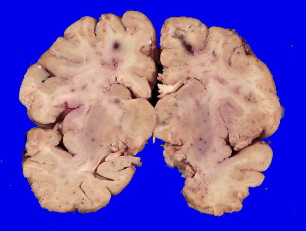 11B1 Fat Embolism (Case 11) _1