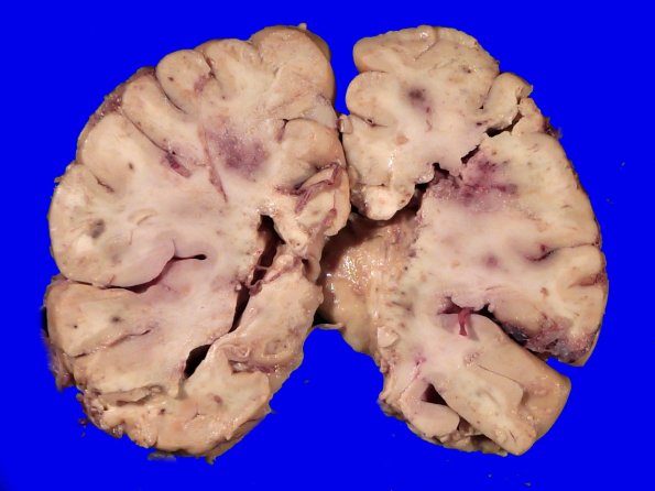 11B2 Fat Embolism (Case 11) _2