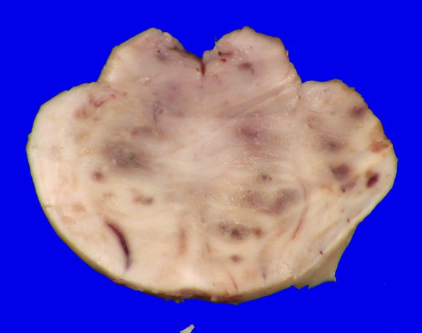 11B3 Fat Embolism (Case 11) _3