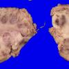 11B3 Fat Embolism (Case 11) _4