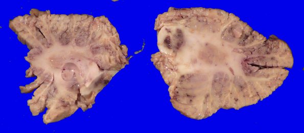 11B3 Fat Embolism (Case 11) _4