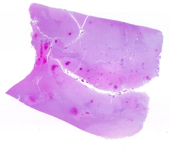 11C1 Fat Embolism (Case 11) H&E N1 WM