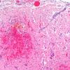 11C2 Fat Embolism (Case 11) H&E N1 10X