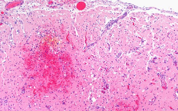 11C2 Fat Embolism (Case 11) H&E N1 10X