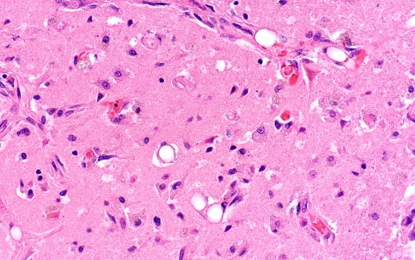 11C4 Fat Embolism (Case 11) H&E N1 20X