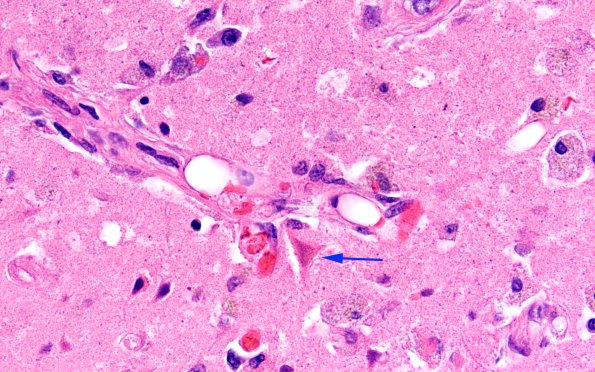 11C5 Fat Embolism (Case 11) H&E N1 60X copy