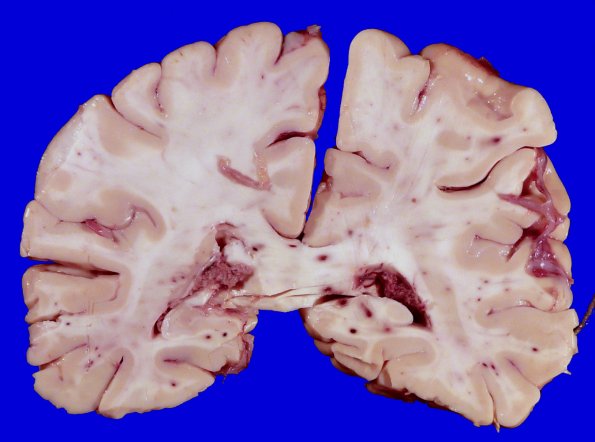 12A1 Fat Embolism (Case 12) Gross _1