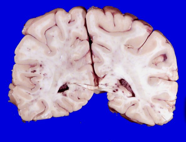 12A2 Fat Embolism (Case 12) Gross _3