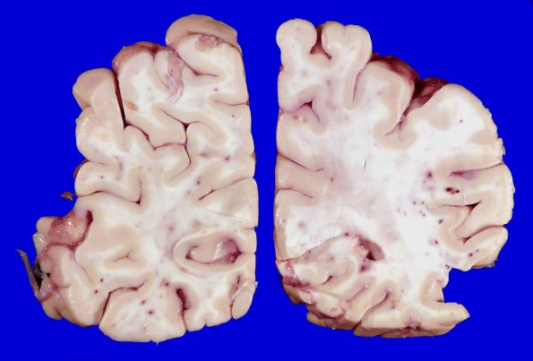 12A3 Fat Embolism (Case 12) Gross _2