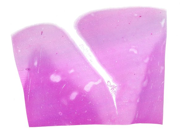 12B1 Fat Embolism (Case 12) N1 WM