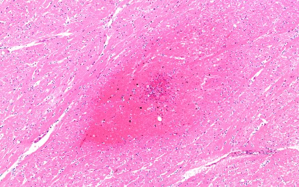 12B10 Fat Embolism (Case 12) int capsuleN12 10X