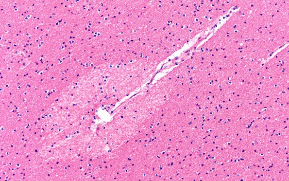 12B11 Fat Embolism (Case 12) N13 20X