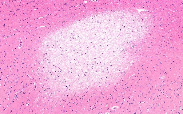 12B12 Fat Embolism (callosum) (Case 12) N13 10X