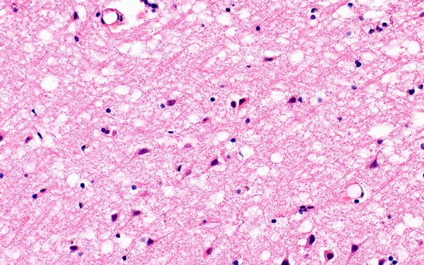 12B13 Fat Embolism (Case 12) N13 40X