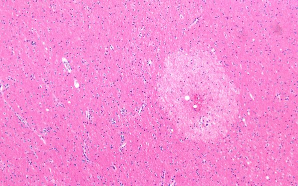 12B2 Fat Embolism (Case 12) N1 10X