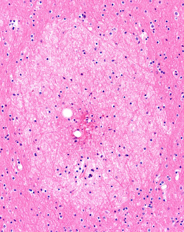 12B3 Fat Embolism (Case 12) N1 20X a