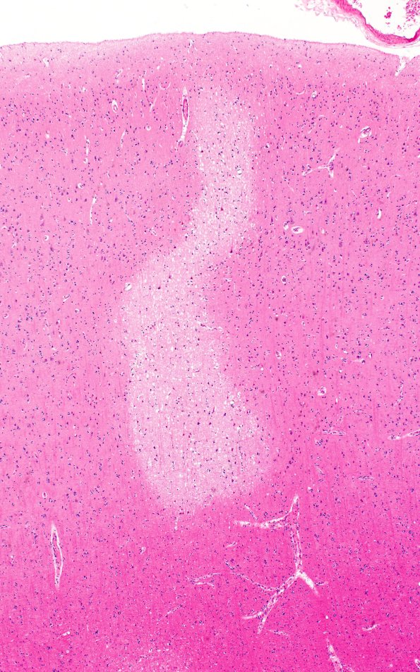 12B4 Fat Embolism (Case 12) N1 4X