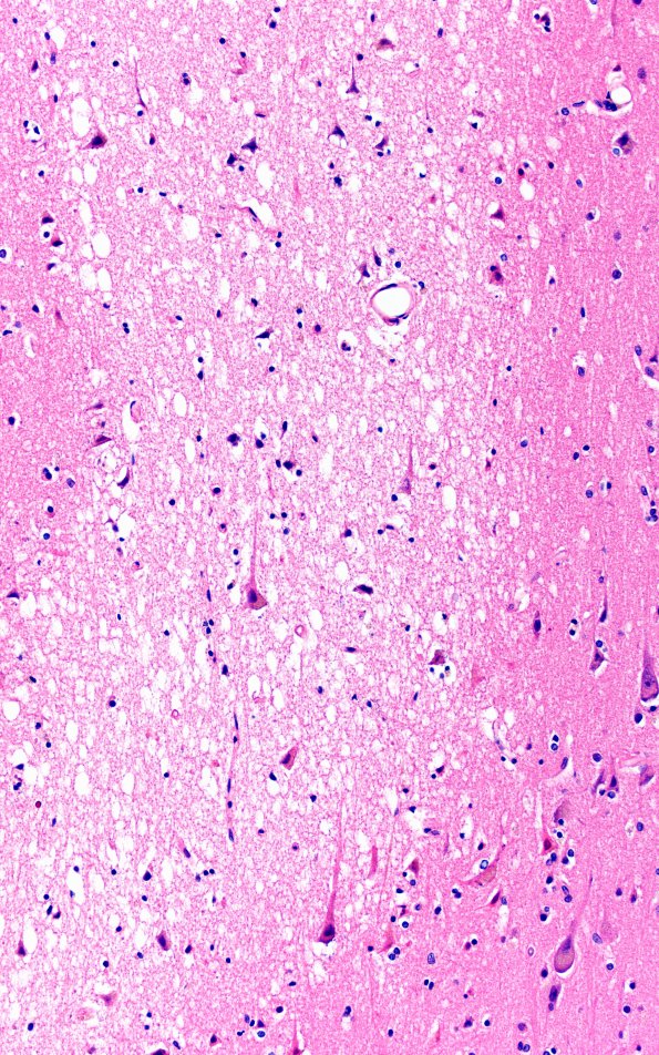 12B5 Fat Embolism (Case 12) N1 20X 3