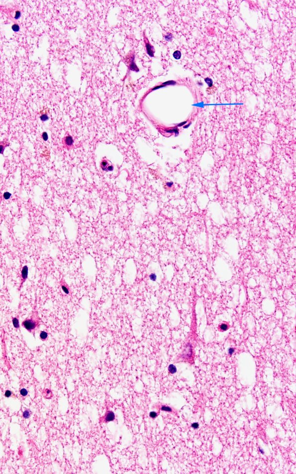 12B6 Fat Embolism (Case 12) N1 60X copy