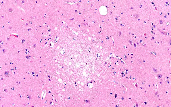 12B7 Fat Embolism (Case 12) N1 20X 2