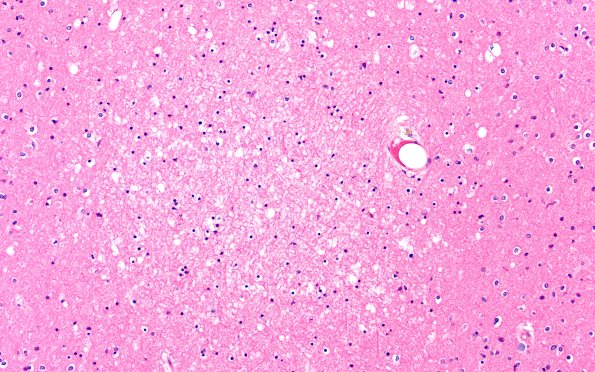 12B8 Fat Embolism (Case 12) occipital N15 20X