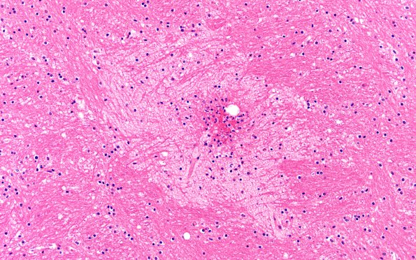 12B9 Fat Embolism (Case 12) int capsule N12 20X