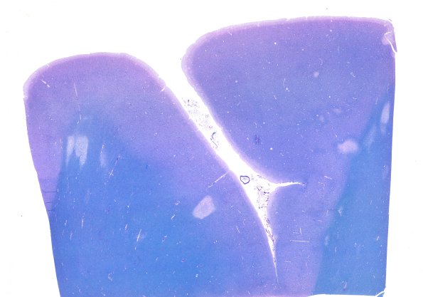 12C1 Fat Embolism (Case 12) LFB-PAS WM