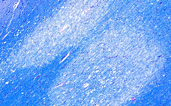 12C2 Fat Embolism (Case 12) LFB-PAS 10X E