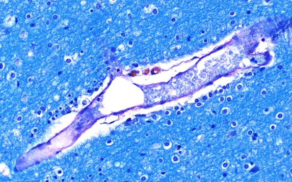 12C4 Fat Embolism (Case 12) LFB-PAS 40X 1