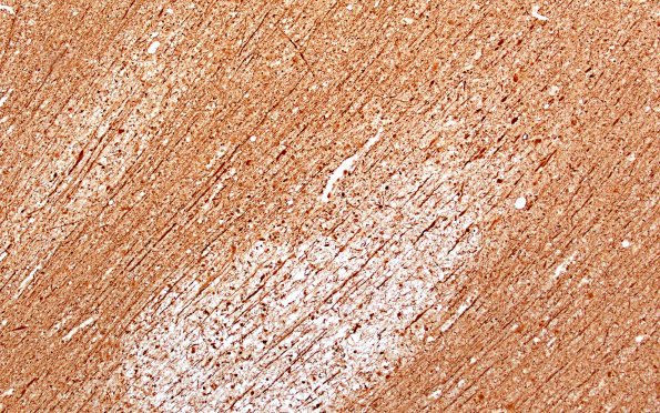 12D3A Fat Embolism (Case 12) NF 10X E