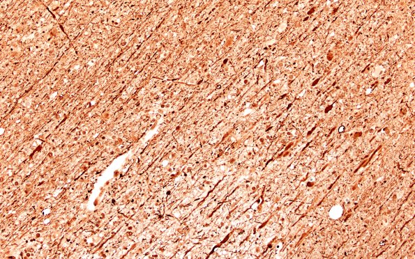 12D3B Fat Embolism (A25-119) NF 20X E