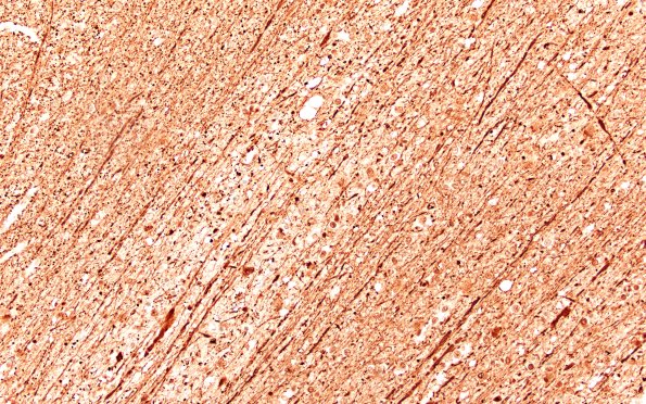 12D3C Fat Embolism (A25-119) NF 20X E 2