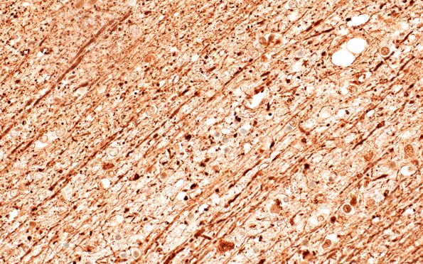 12D3D Fat Embolism (A25-119) NF 40X E 3