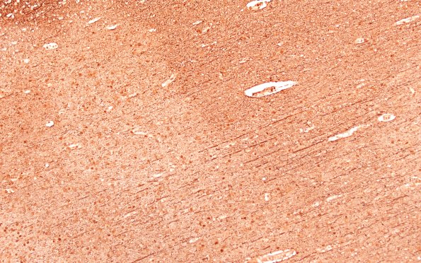 12D5A Fat Embolism (Case 12) NF 10X 3