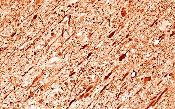 12D5B Fat Embolism (Case 12) NF 40X E 2