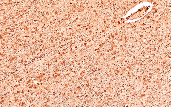 12D5C Fat Embolism (Case 12) NF 20X E 5
