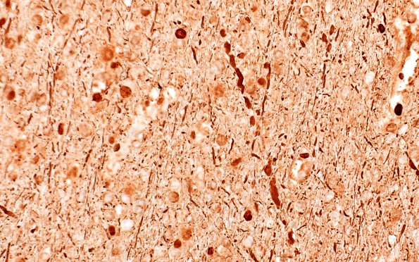 12D5D Fat Embolism (Case 12) NF 40X E 5