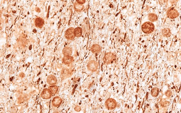 12D5E Fat Embolism (Case 12) NF 100X E 7