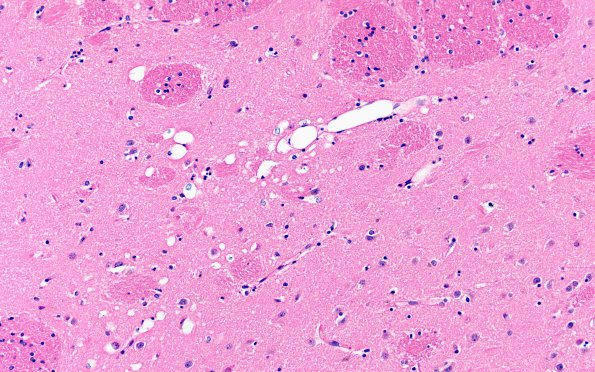 12E1 Fat Embolism (Case 12) N2 20X