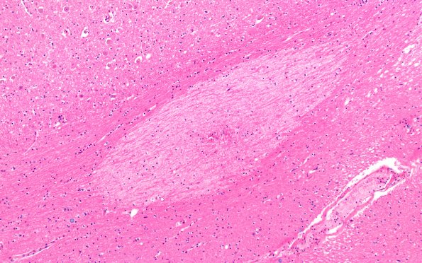 12E2 Fat Embolism (Case 12) N4 10X