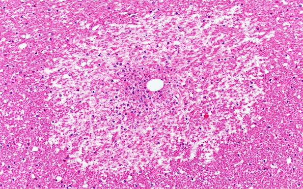 12E3 Fat Embolism (Case 12) N4 20X 2